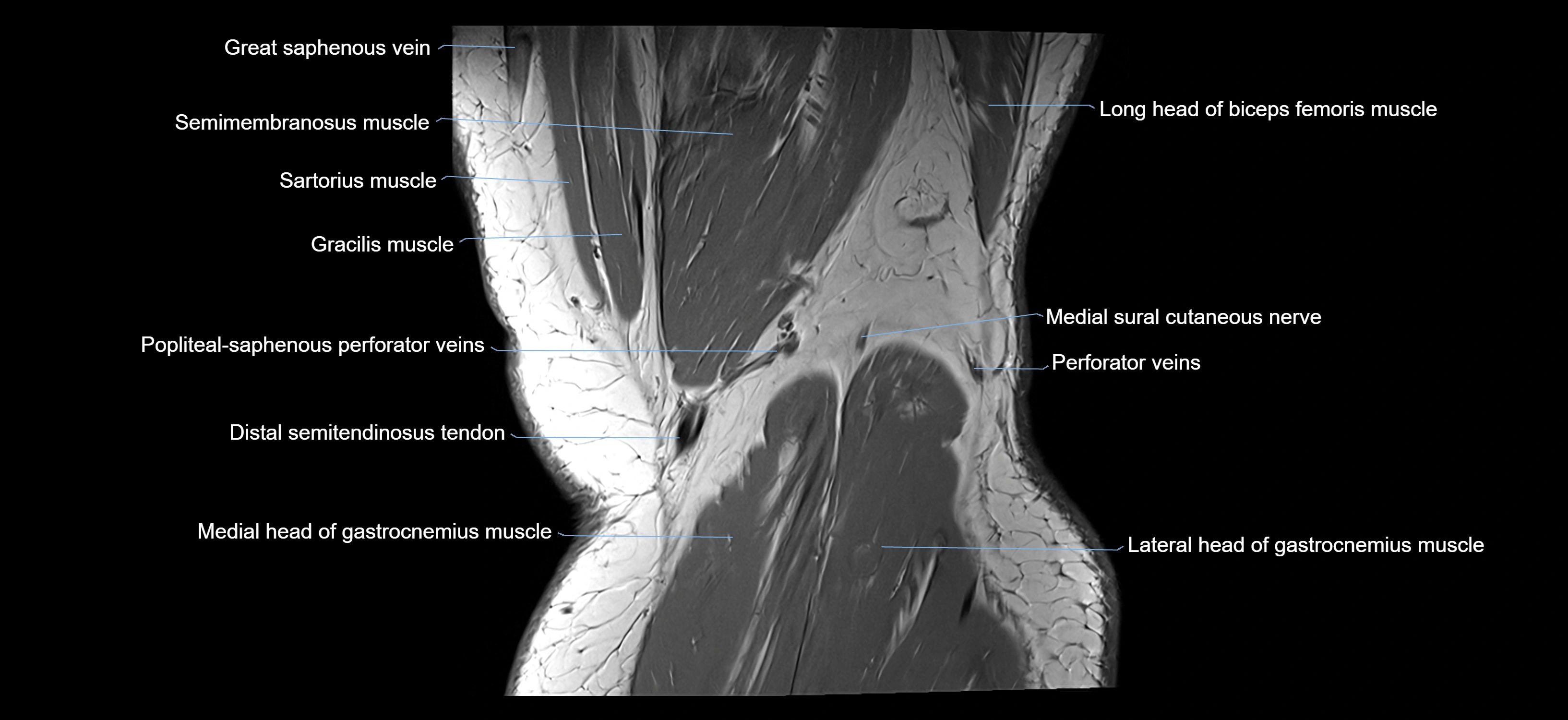 MRI knee coronal cross sectional anatomy labelled 3T radiology  image-04001-00040.webp